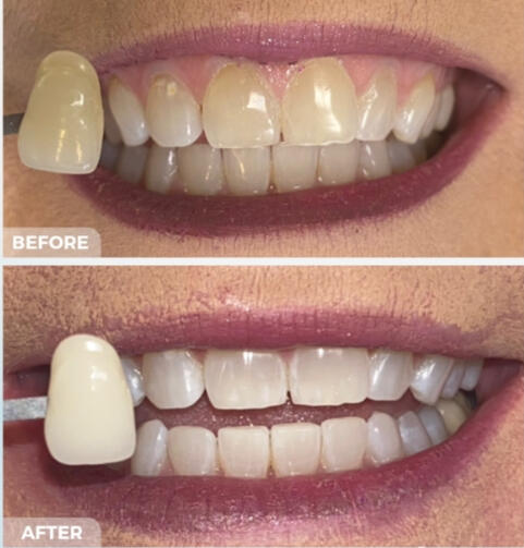 White Enhancement White Enhancement
