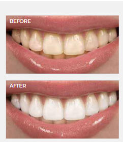 White Enhancement